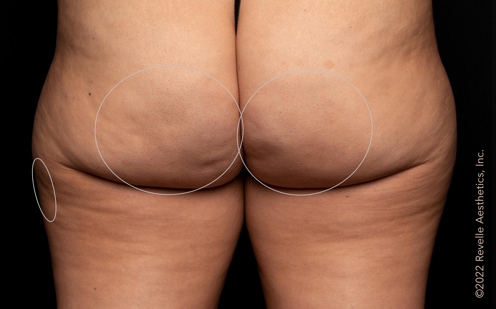 Avéli Cellulite Treatment After