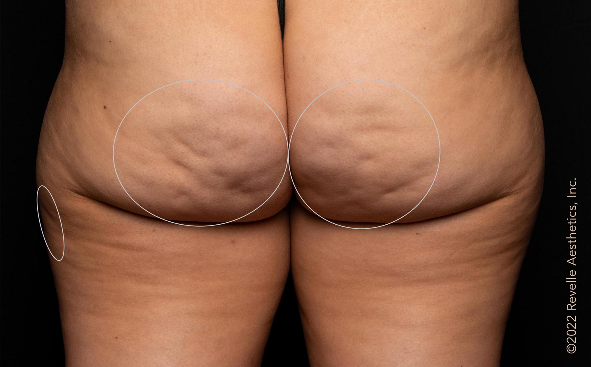 Avéli Cellulite Treatment Before