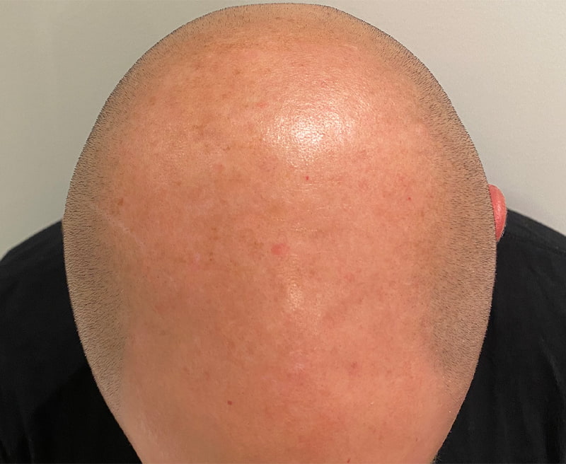 Lumecca IPL Before & After Image