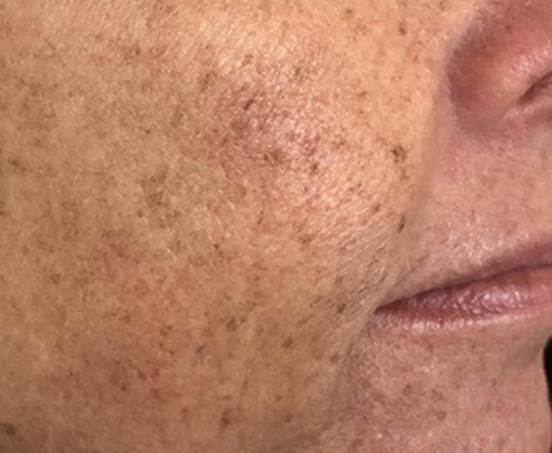 Lumecca IPL Before & After Image