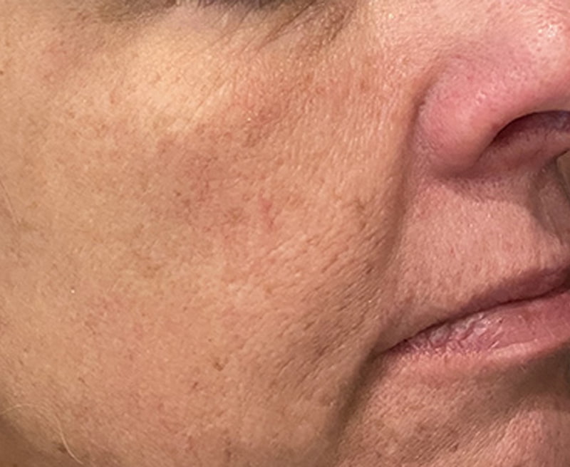 Lumecca IPL Before & After Image