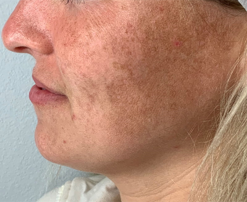 Lumecca IPL Before & After Image